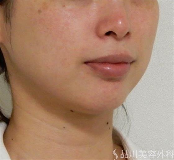 症例NO.38652のBEFORE写真
