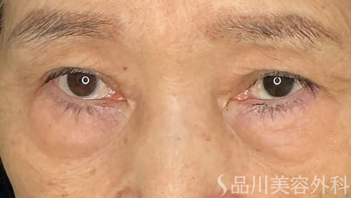 症例NO.71889のBEFORE写真