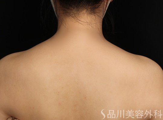 症例NO.71184のAFTER写真