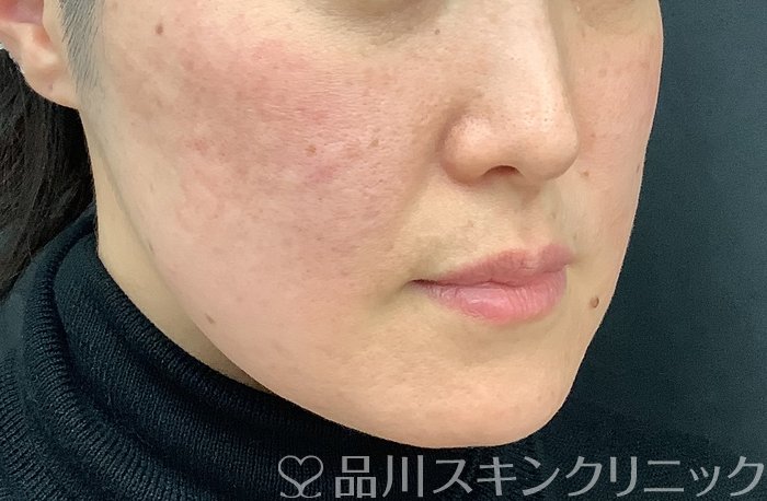 症例NO.69484のBEFORE写真