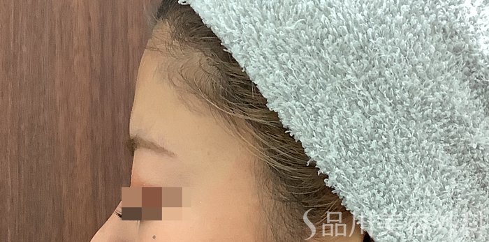 症例NO.69483のBEFORE写真