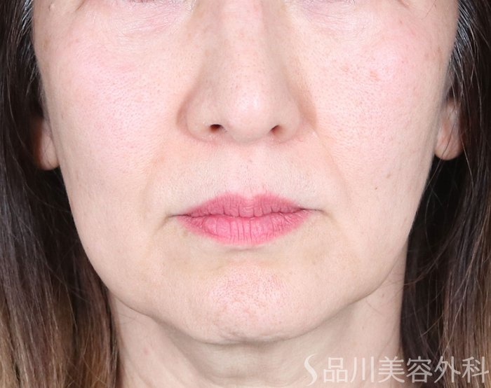 症例NO.73006のBEFORE写真