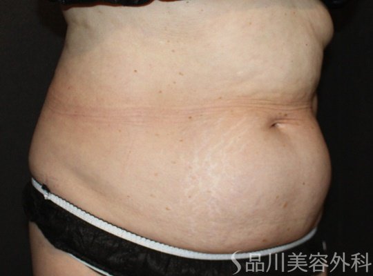 症例NO.74886のBEFORE写真