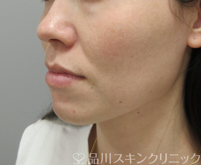 症例NO.73182のBEFORE写真