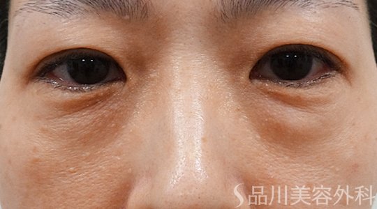 症例NO.73438のBEFORE写真