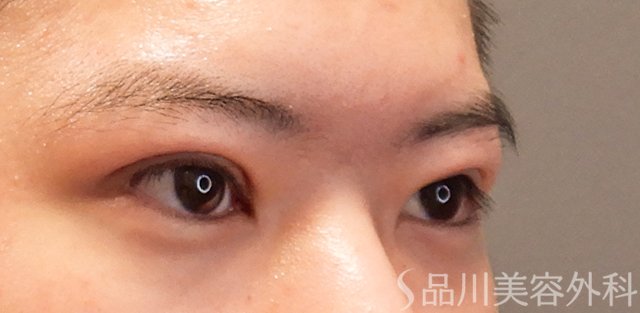 症例NO.72454のAFTER写真