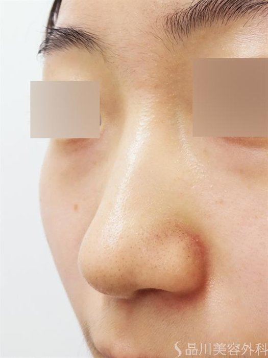 症例NO.33249のBEFORE写真