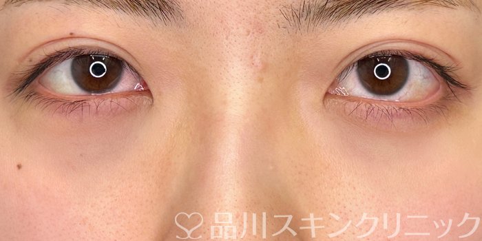 症例NO.64937のAFTER写真