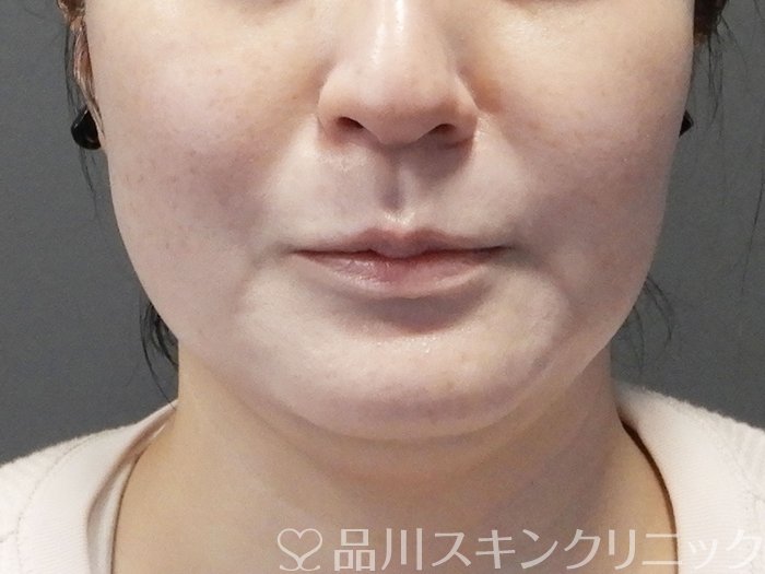 症例NO.73440のAFTER写真