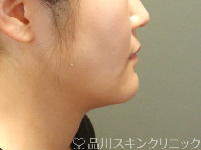 症例NO.65671のBEFORE写真
