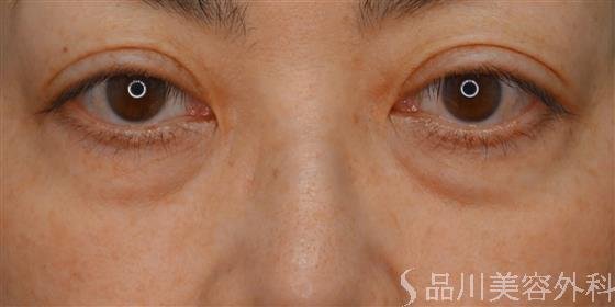 症例NO.61385のBEFORE写真
