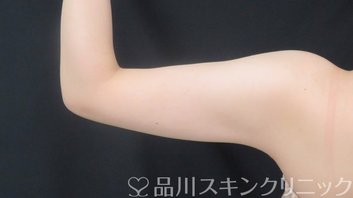 症例NO.70884のAFTER写真