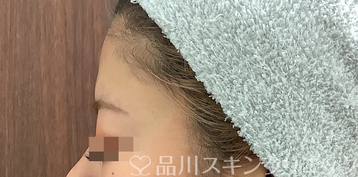 症例NO.69483のBEFORE写真