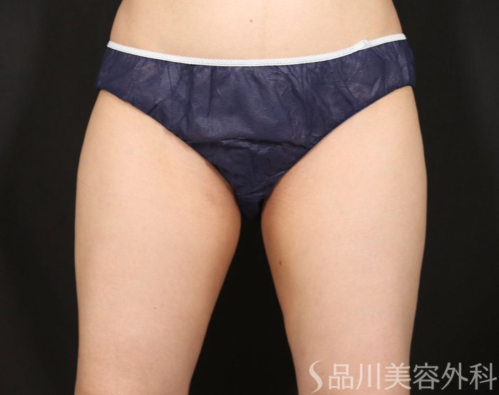 症例NO.74098のAFTER写真