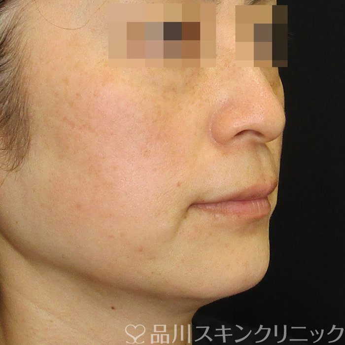 症例NO.75212のAFTER写真