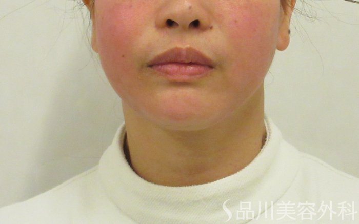 症例NO.72297のAFTER写真