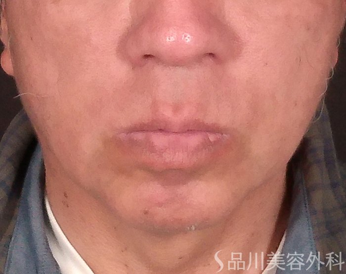 症例NO.69414のAFTER写真
