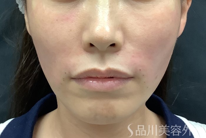 症例NO.71531のAFTER写真