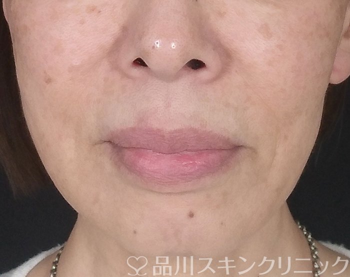 症例NO.69664のBEFORE写真