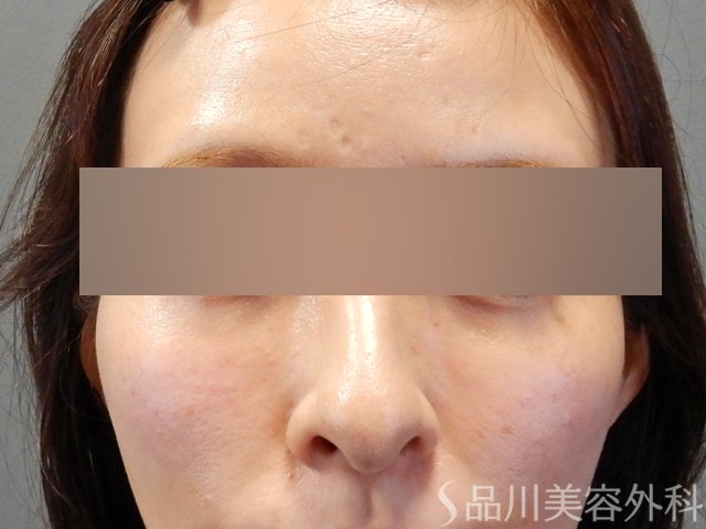 症例NO.67974のAFTER写真