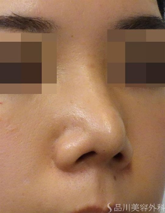 症例NO.39898のAFTER写真