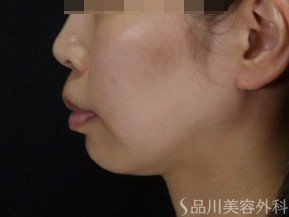 症例NO.71313のBEFORE写真