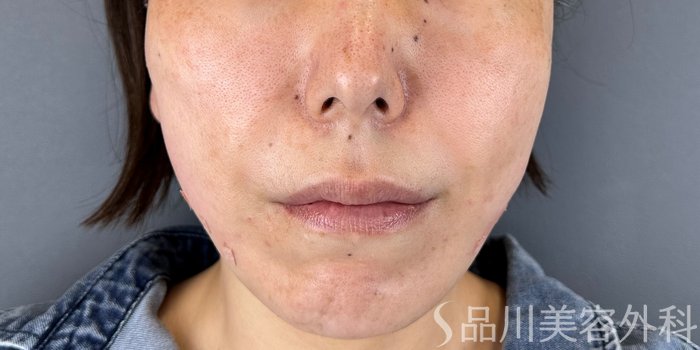 症例NO.70177のAFTER写真
