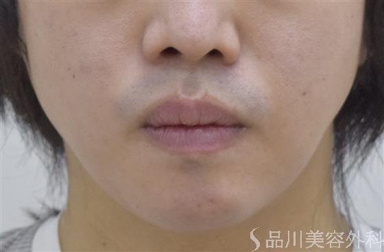 症例NO.47916のAFTER写真