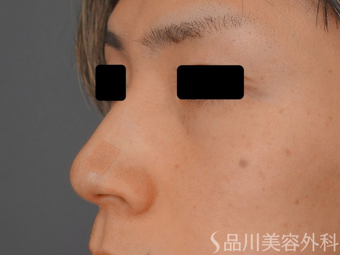 症例NO.74697のAFTER写真