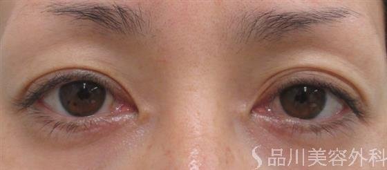 症例NO.23899のBEFORE写真