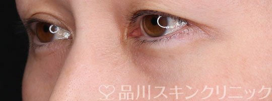 症例NO.69670のBEFORE写真