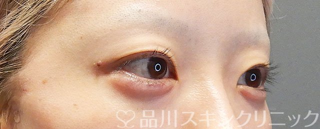 症例NO.72453のAFTER写真