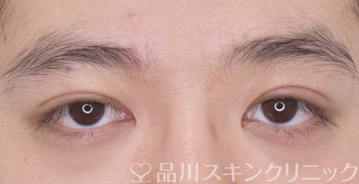 症例NO.64807のAFTER写真