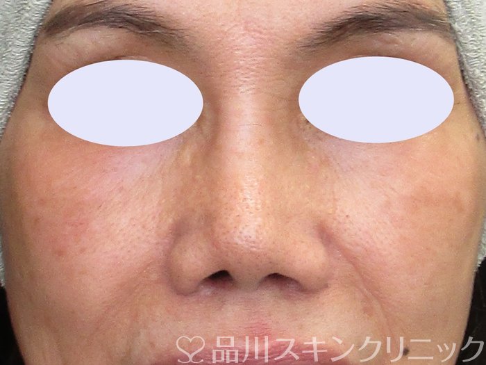 症例NO.73305のAFTER写真