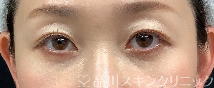 症例NO.71034のAFTER写真