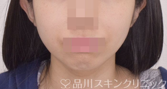 症例NO.64667のBEFORE写真