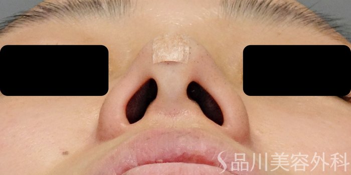 症例NO.71100のAFTER写真