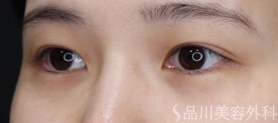症例NO.67638のBEFORE写真