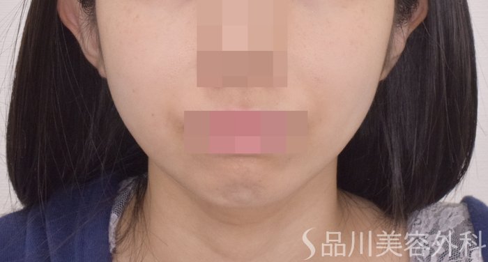 症例NO.64667のBEFORE写真