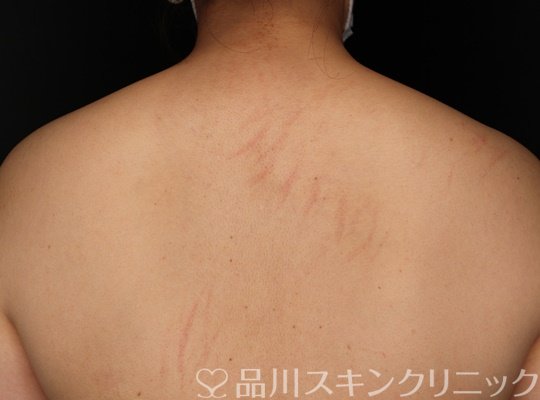 症例NO.70187のBEFORE写真