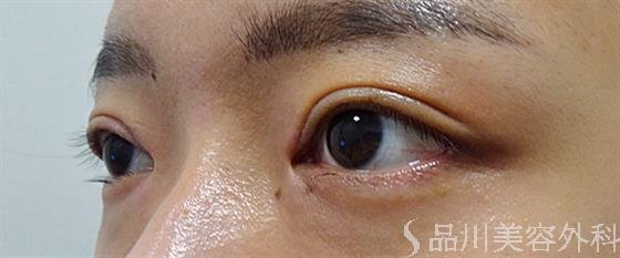 症例NO.54017のAFTER写真