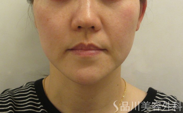 症例NO.69900のBEFORE写真
