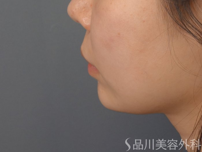 症例NO.72737のBEFORE写真