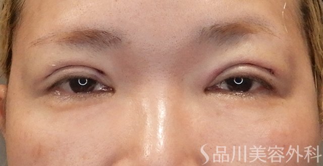 症例NO.74771のAFTER写真