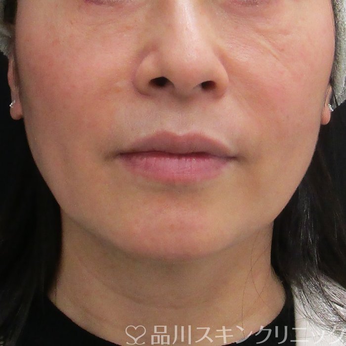 症例NO.73519のBEFORE写真