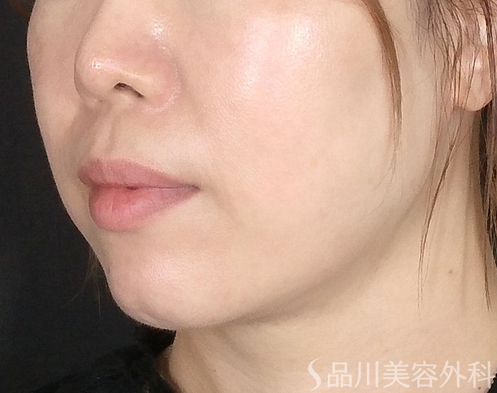 症例NO.64880のBEFORE写真