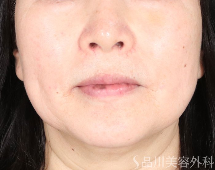 症例NO.72526のBEFORE写真