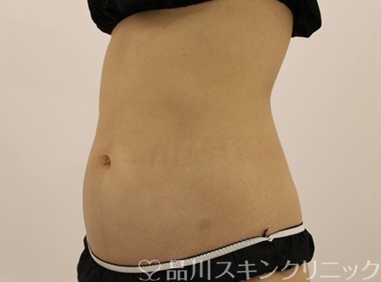 症例NO.71858のBEFORE写真