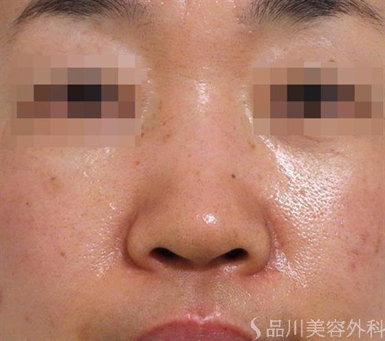 症例NO.36508のBEFORE写真