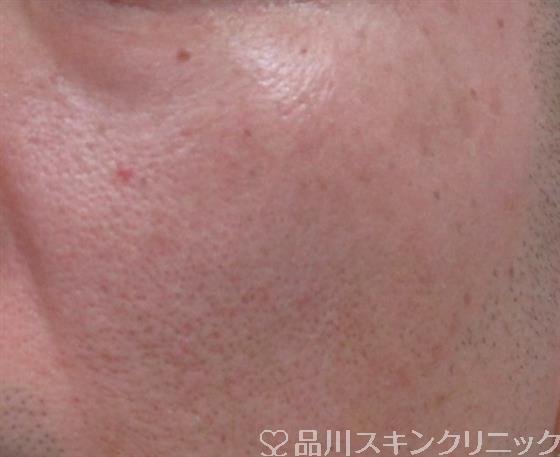 症例NO.33662のAFTER写真